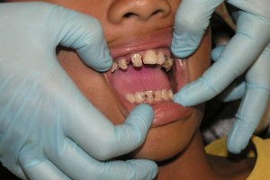 洗牙过后注意事项洗牙以后正确保养方法